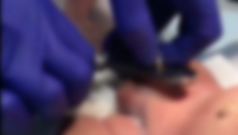 Regina, Swift Current, Saskatoon circumcision clinic